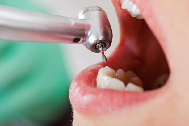 Best Emergency Root Canal Treatment in Hinsdale, IL